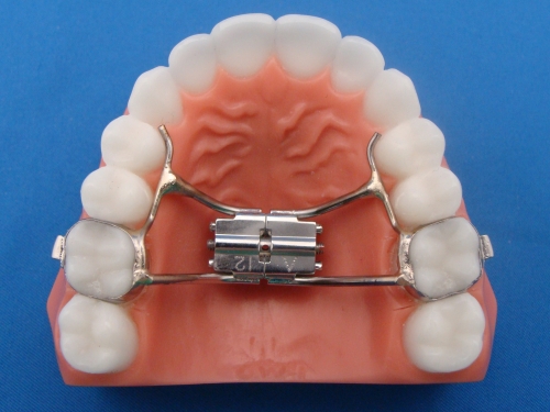 Fixed and Removable Appliances | CPW Orthodontics